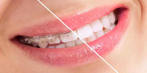 Straighter whiter teeth